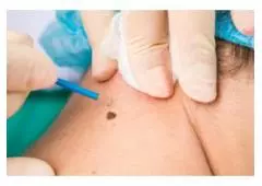 Seeking Genital Warts Removal in London? Visit London Dermatology Clinics!
